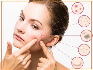 laser acne treatment