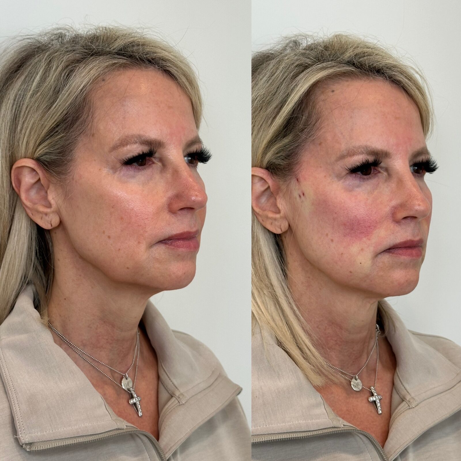 pdo thread lift treatment