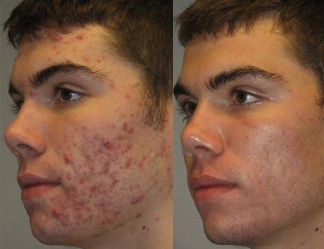 face After Acne Laser Treatment