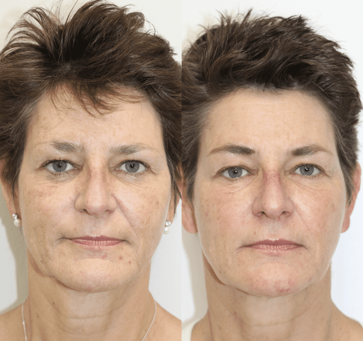 Biostimulators – Sculptra treatment