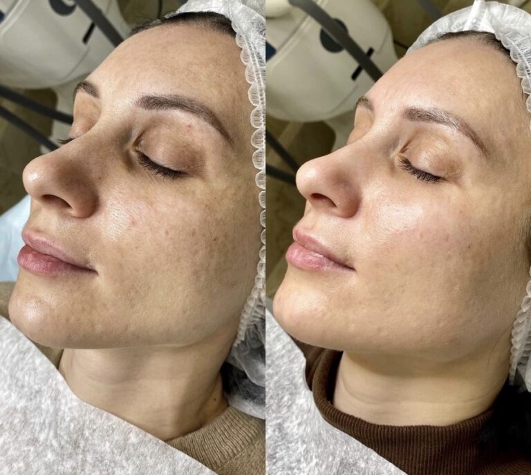 face after Hollywood Carbon Facial