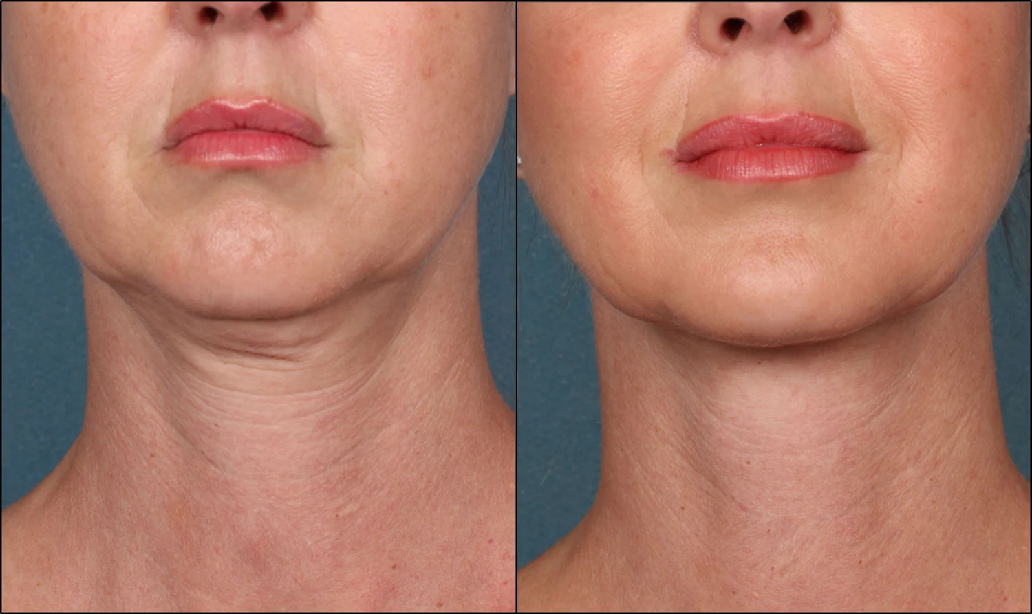 Radio Frequency Skin Tightening treatment