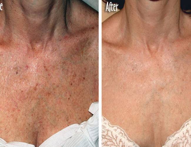 women skin after Pigmented Lesion Treatment