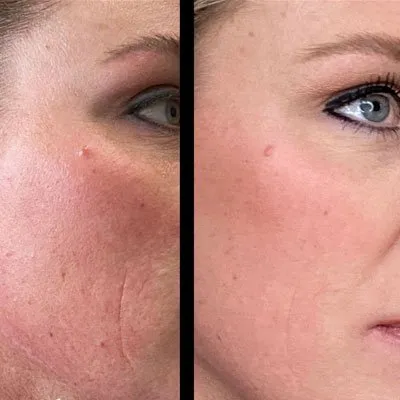 women after Glowtox Facial