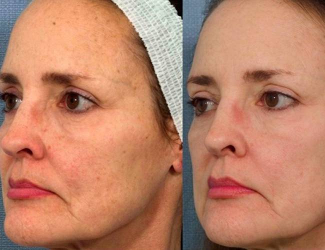 face after Vascular Lesion Treatment