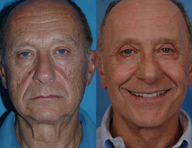 men after Skin Rejuvenation treatment