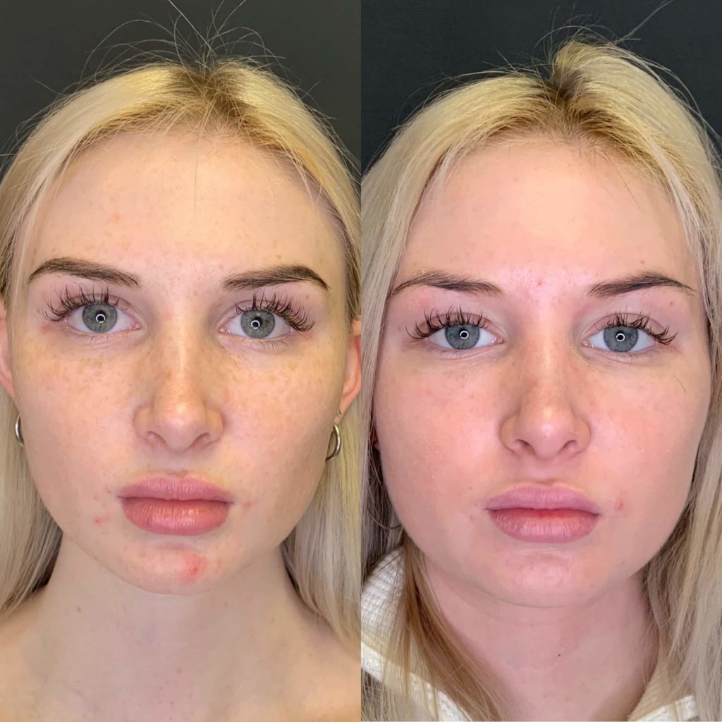 Face After Microneedling with PRP