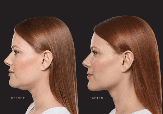 before and after Belkyra treatment