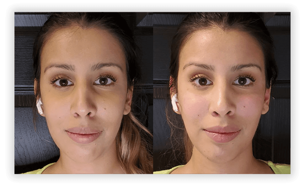 women face after Dermal Fillers