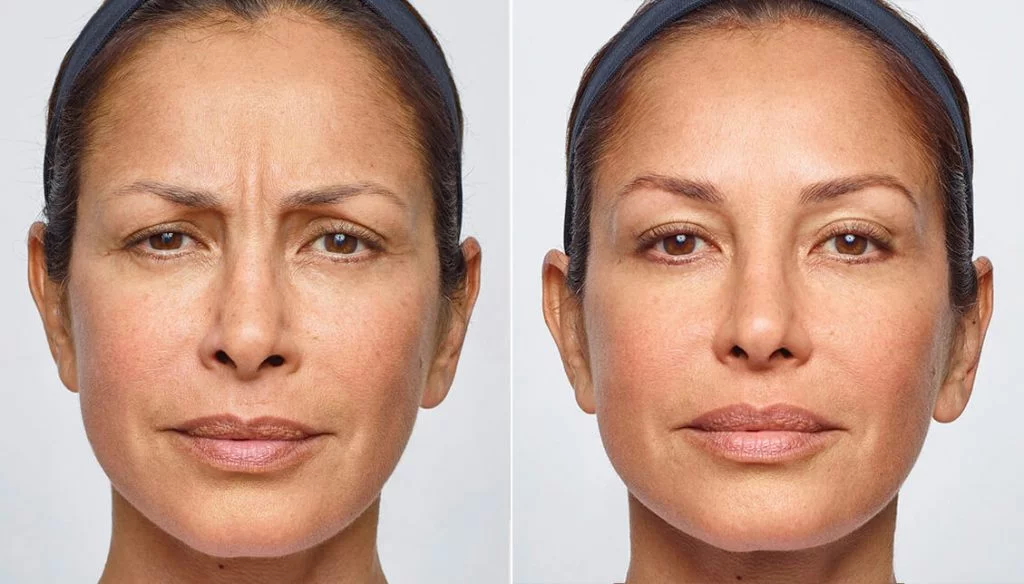 women face after Dysport Injections