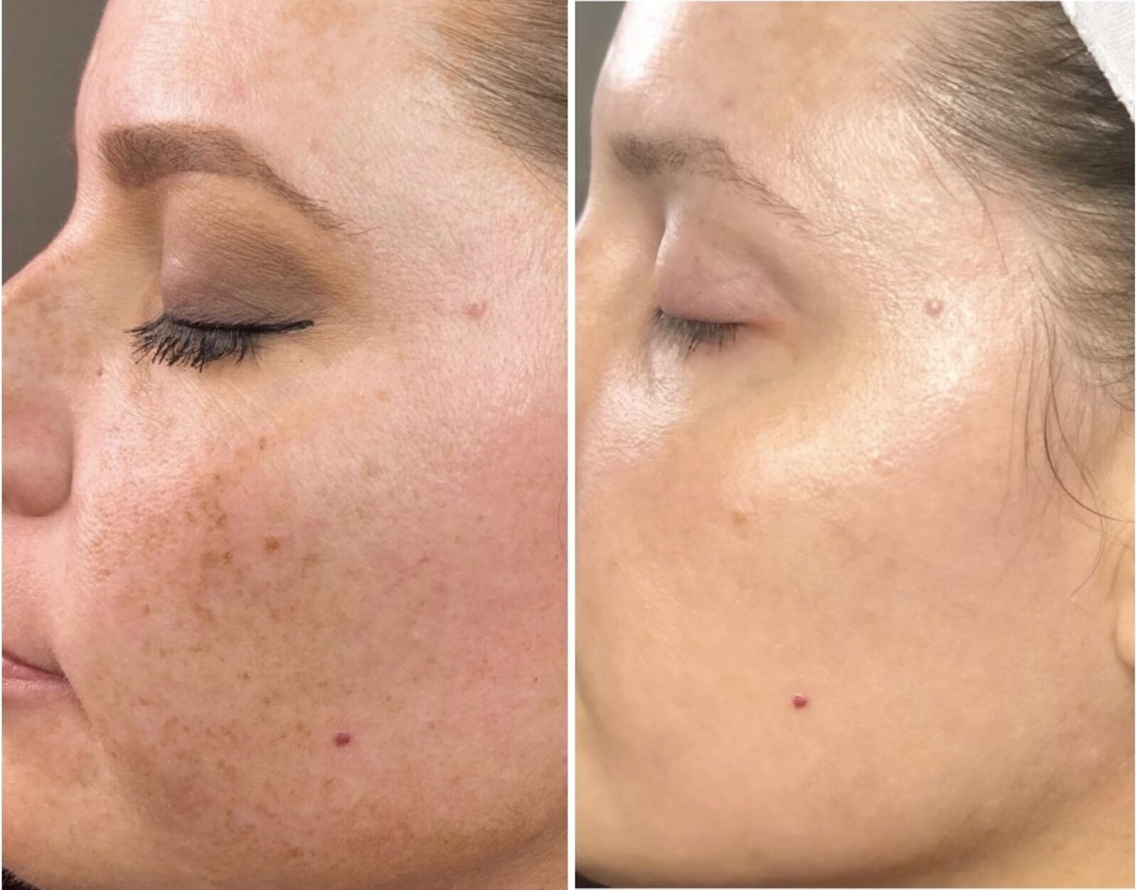 Laser Genesis treatment