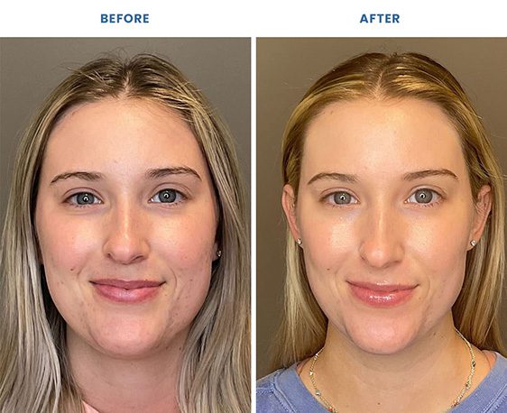 skin treatment before and after