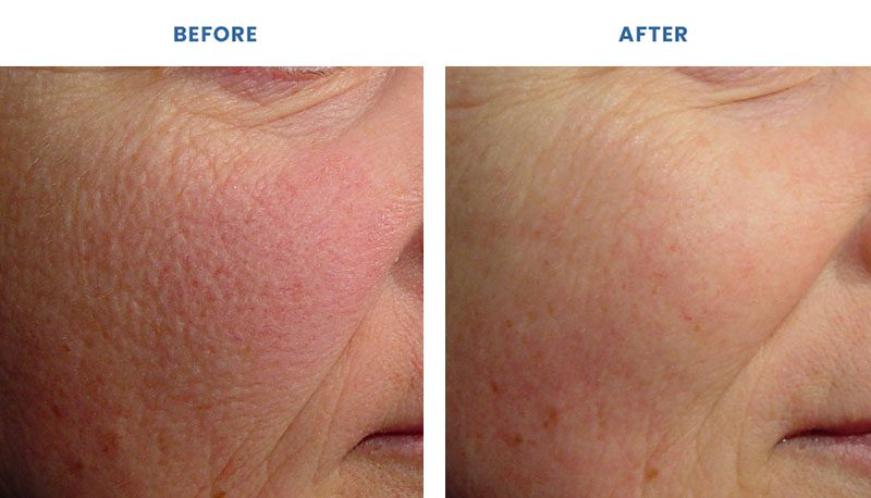 skin treatment of laser genesis