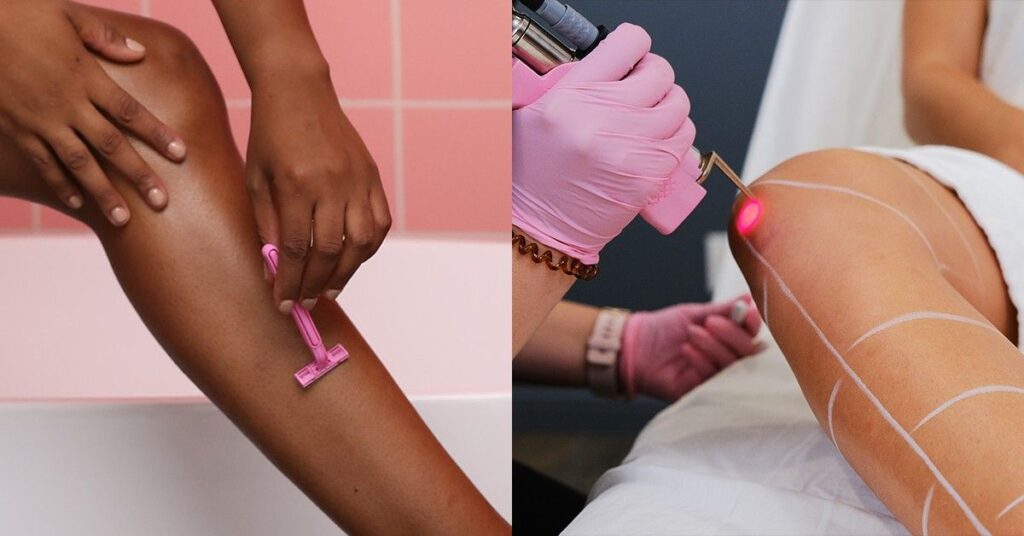 Laser Hair Removal treatment