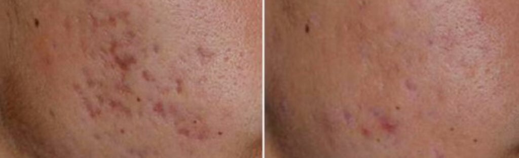 laser acne treatment