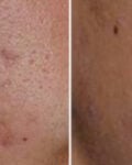 How Can You Achieve Clear Skin with Acne Treatment at Oxyderm Laser Clinic Edmonton?
