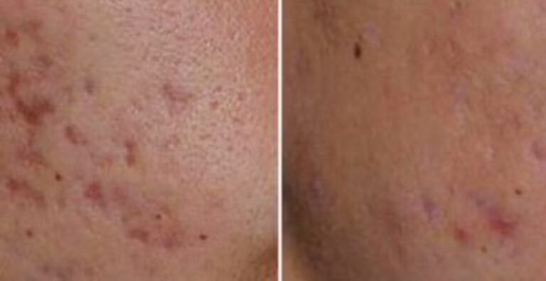 laser acne treatment