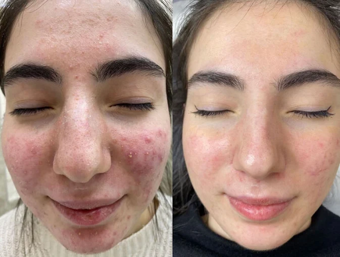 women with acne face