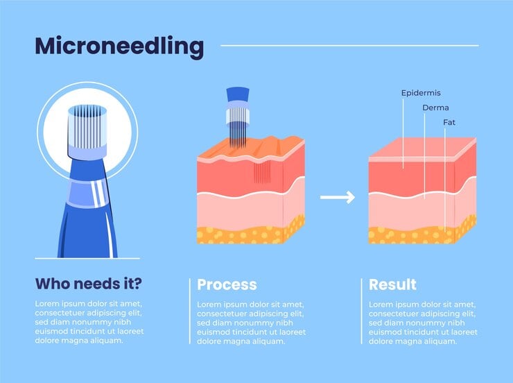 process of micro-needling