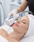 Why Choose Professional Acne Scars Treatment in Edmonton