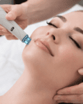 Why Should You Get Monthly Microdermabrasion at Oxyderm Laser Clinic & Academy Edmonton?