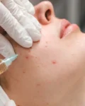 Best Acne Spot Treatment: Your Ultimate Guide to Clear Skin