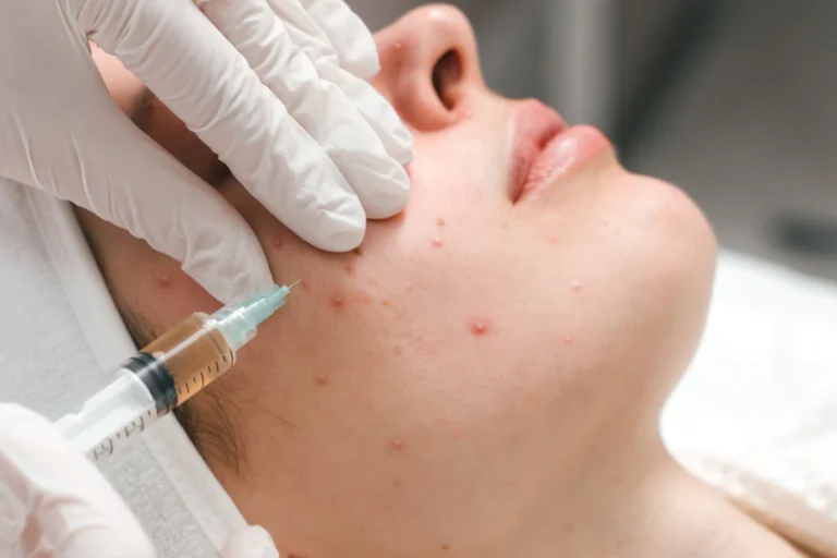 Acne Spot Treatment