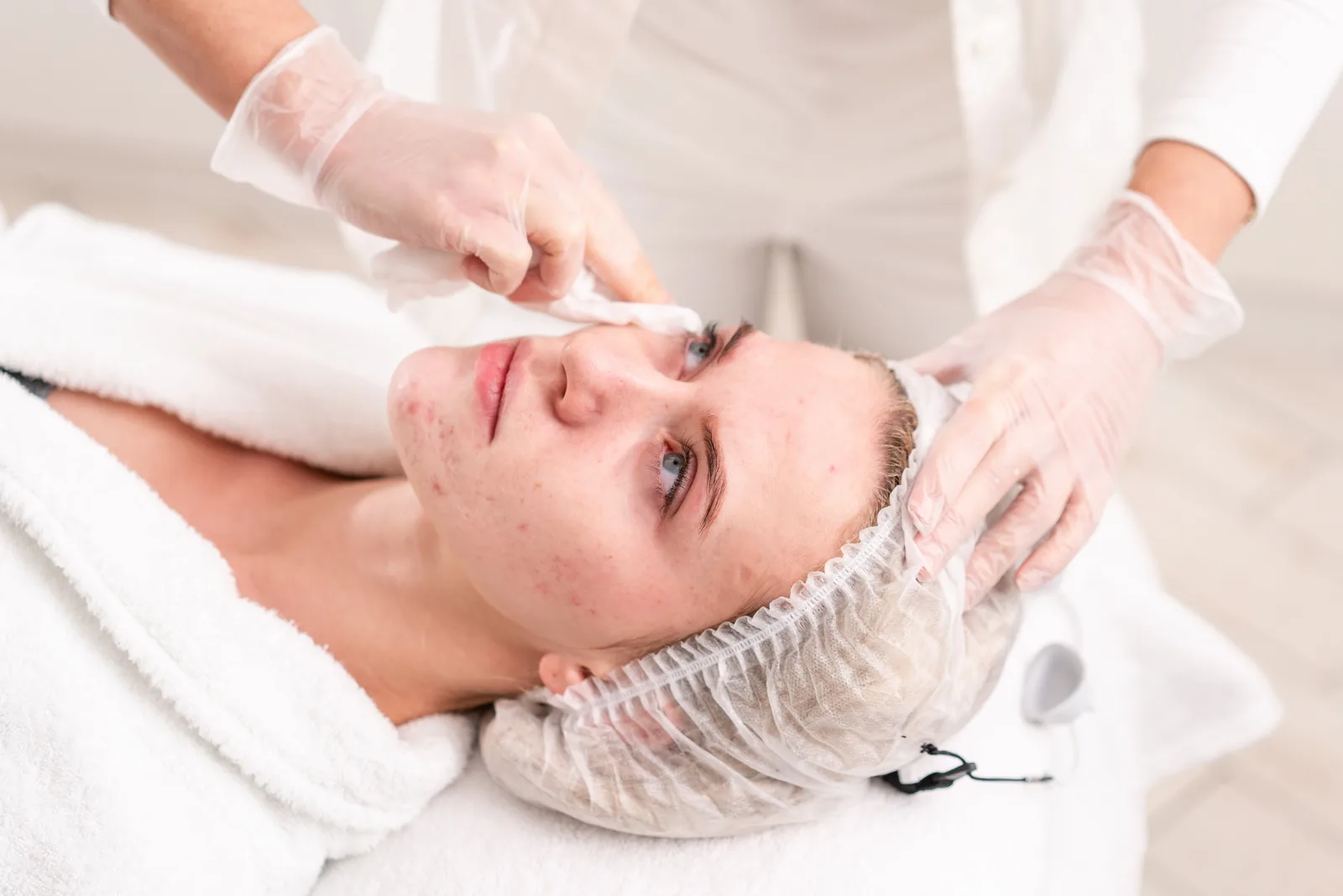Back Acne: What Order to Treat It In, and Why That Order Matters