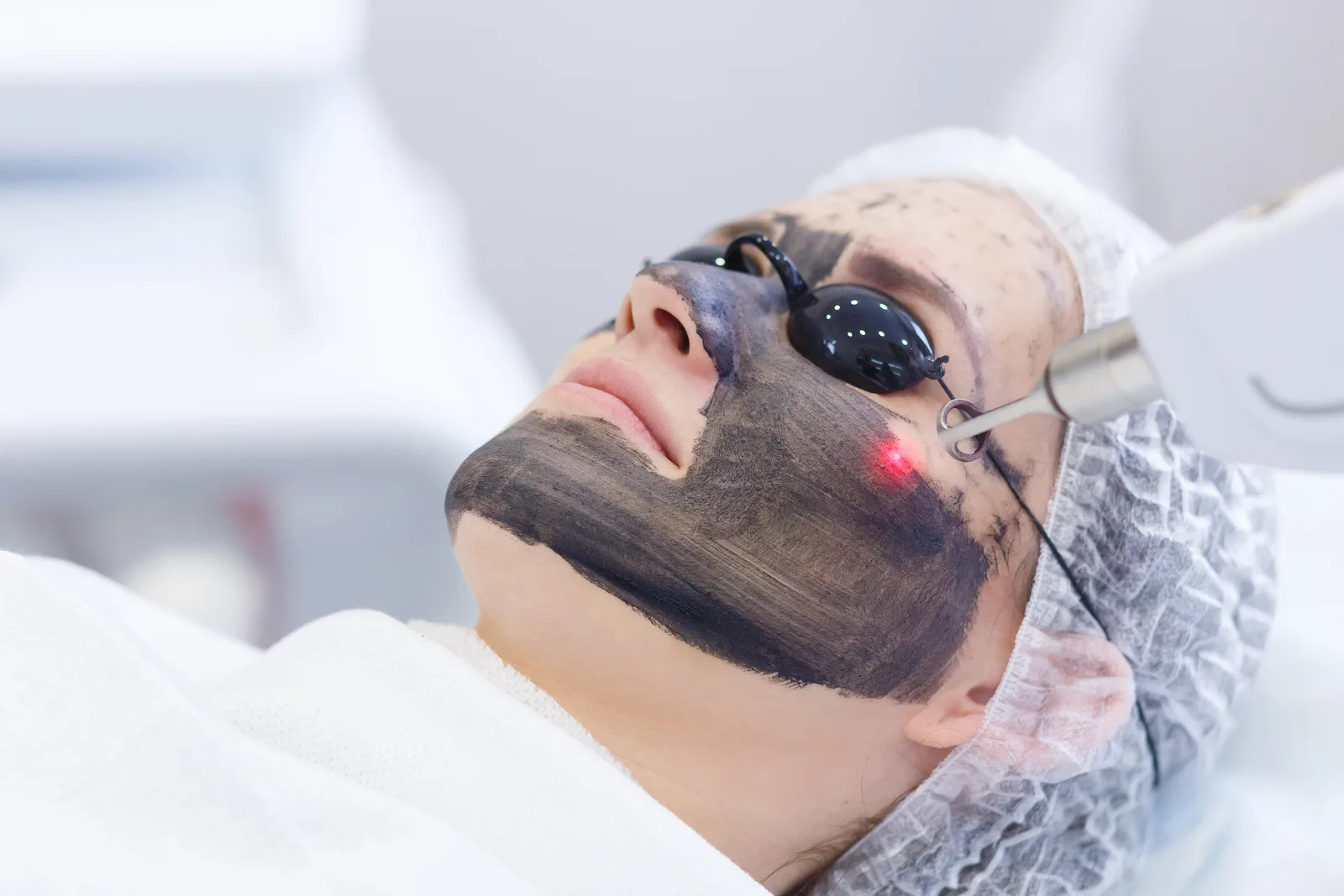 The Hollywood Carbon Facial: What It Is, Who It’s For and Why It’s Called the “Red-Carpet Peel”