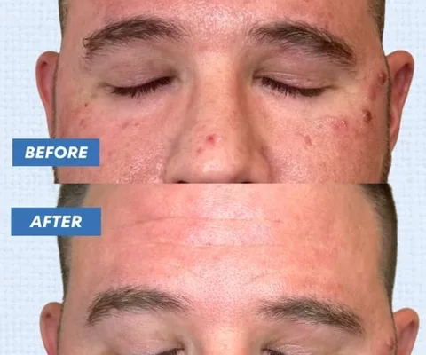 Forehead before and after acne treatment at Oxyderm