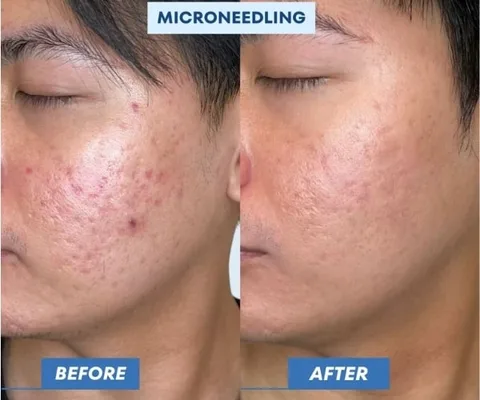Cheek before and after microneedling for acne scarring at Oxyderm