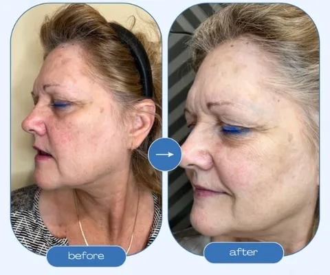 Face before and after skin rejuvenation at Oxyderm