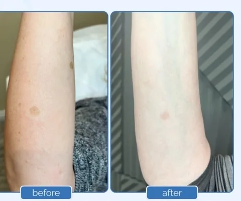 Arm before and after skin treatment at Oxyderm