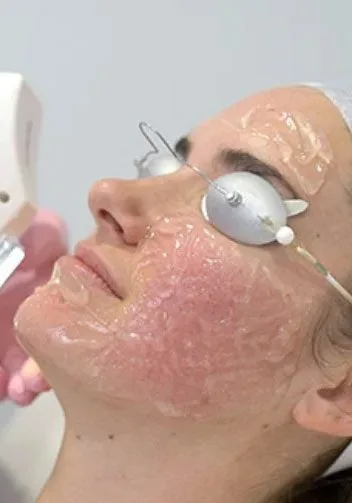 IPL PhotoFacial for Rosacea and Facial Redness: What It Can (and Can’t) Do