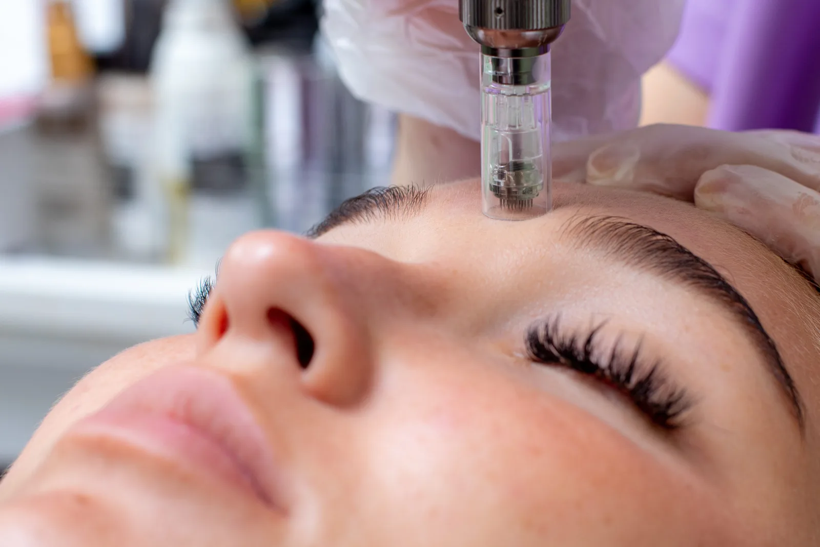 Microneedling at Oxyderm Laser Clinic Edmonton