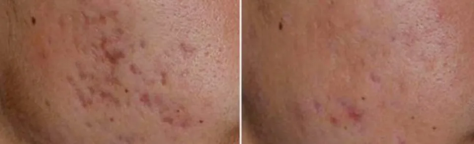 How Can You Achieve Clear Skin with Acne Treatment at Oxyderm Laser Clinic Edmonton?