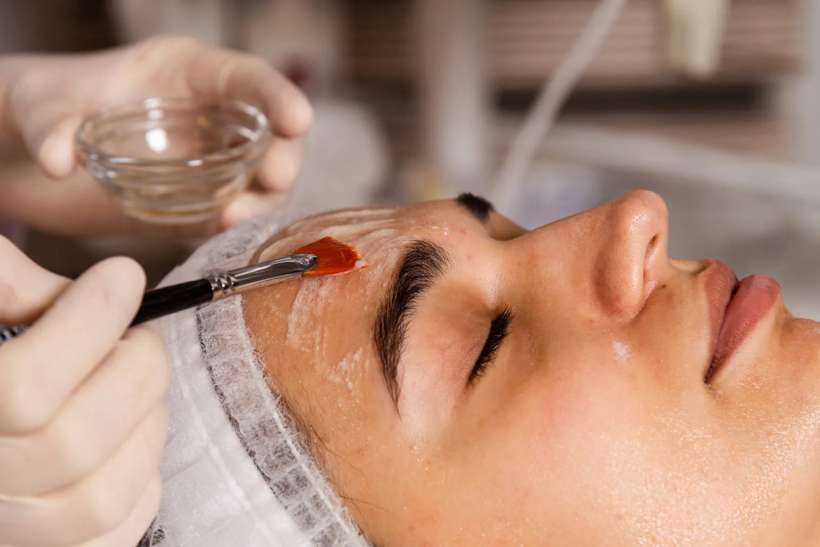 Chemical Peels Explained: Light, Medium and Deep, Which One Does Your Skin Need?