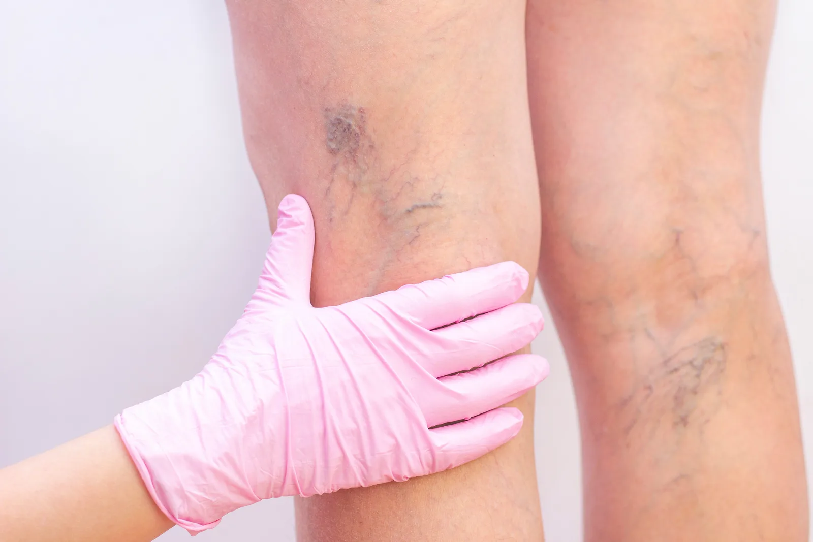 Spider Vein Treatment at Oxyderm Laser Clinic and Academy Edmonton