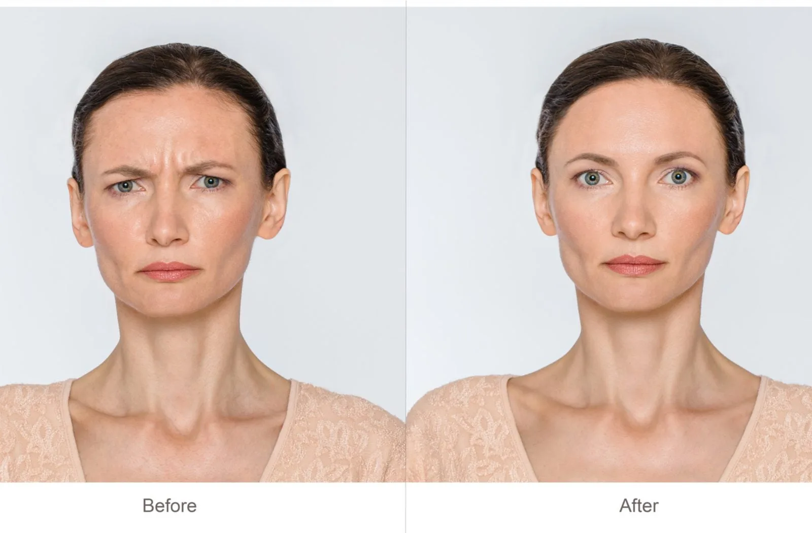 Nuceiva Injections: See the Difference