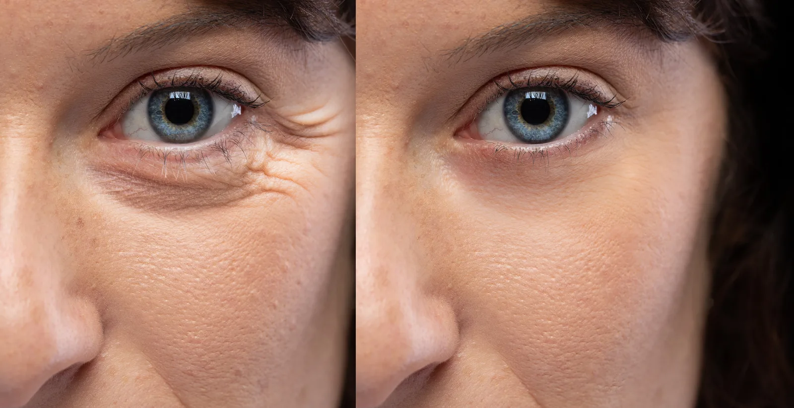 Botox Injections: See the Results for Yourself
