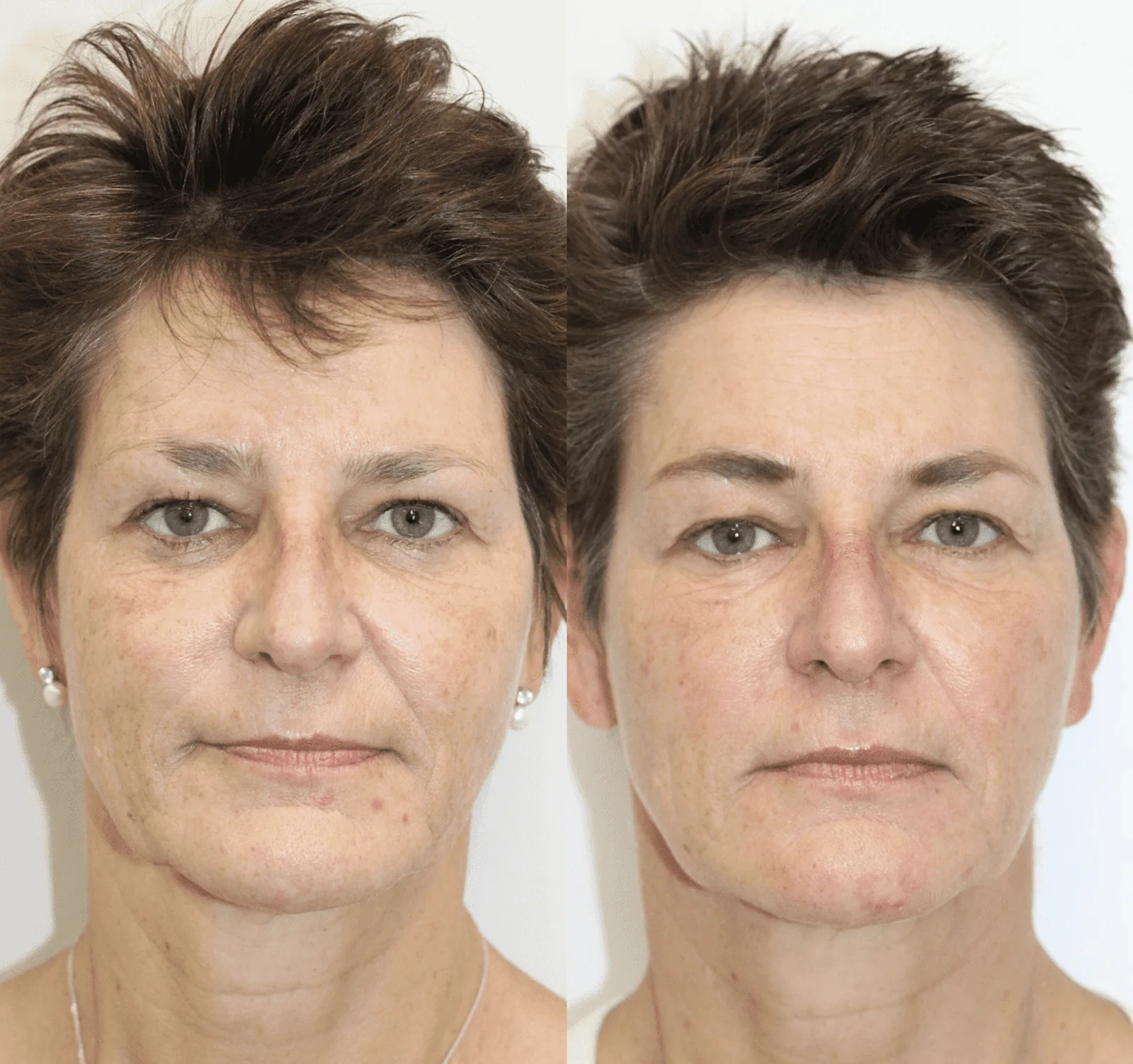 Sculptra Biostimulator: See the Results for Yourself