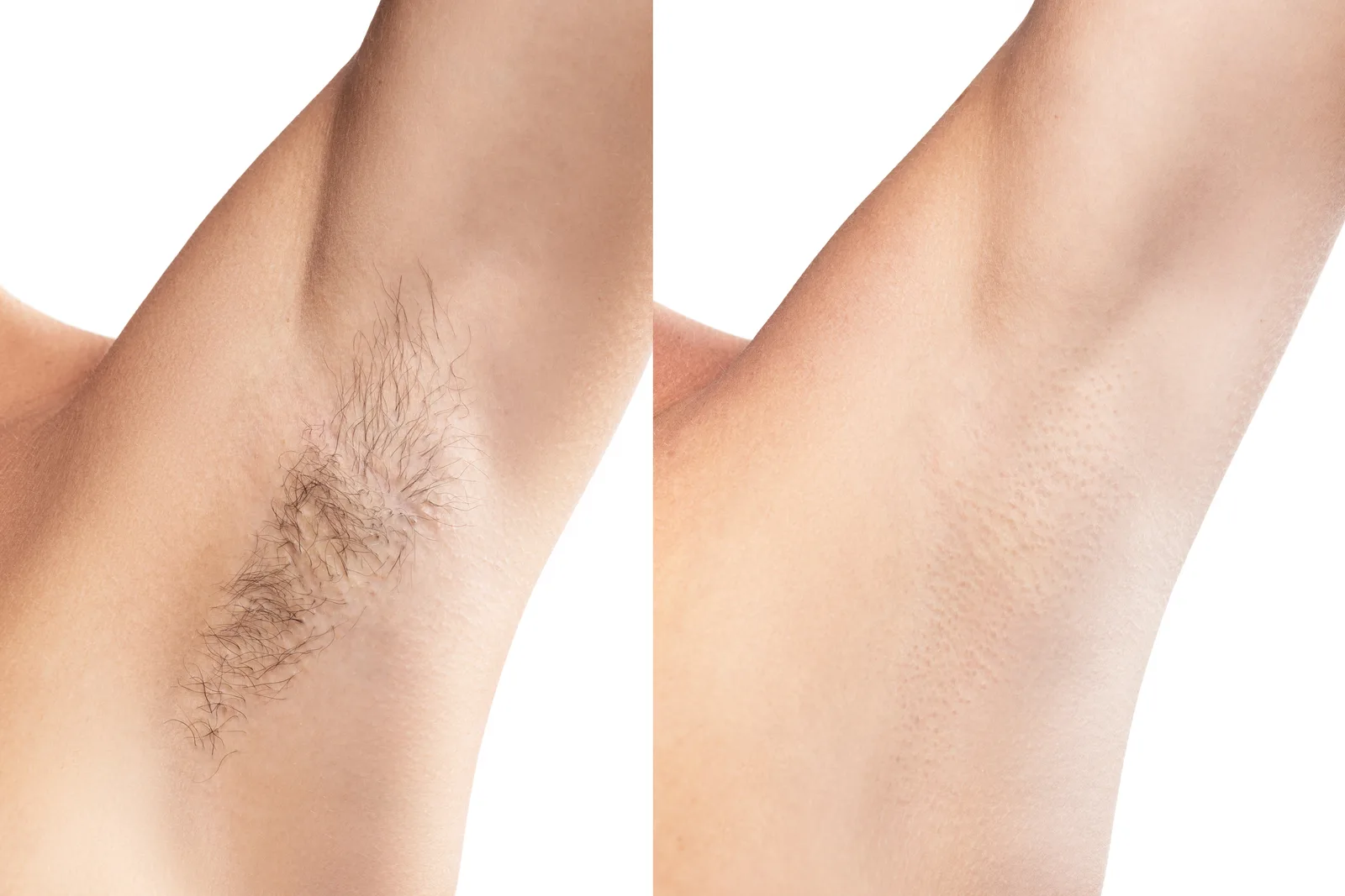 Laser Hair Removal: See the Results for Yourself