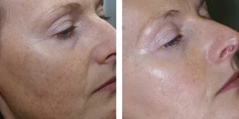 Laser Genesis: See the Results for Yourself