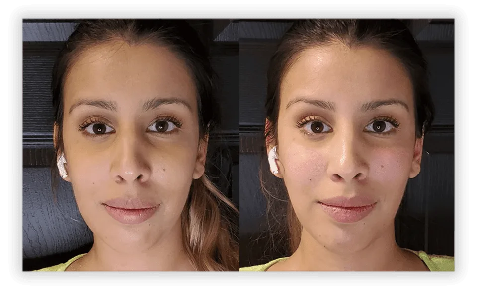 Fillers by Zone: See the Results for Yourself