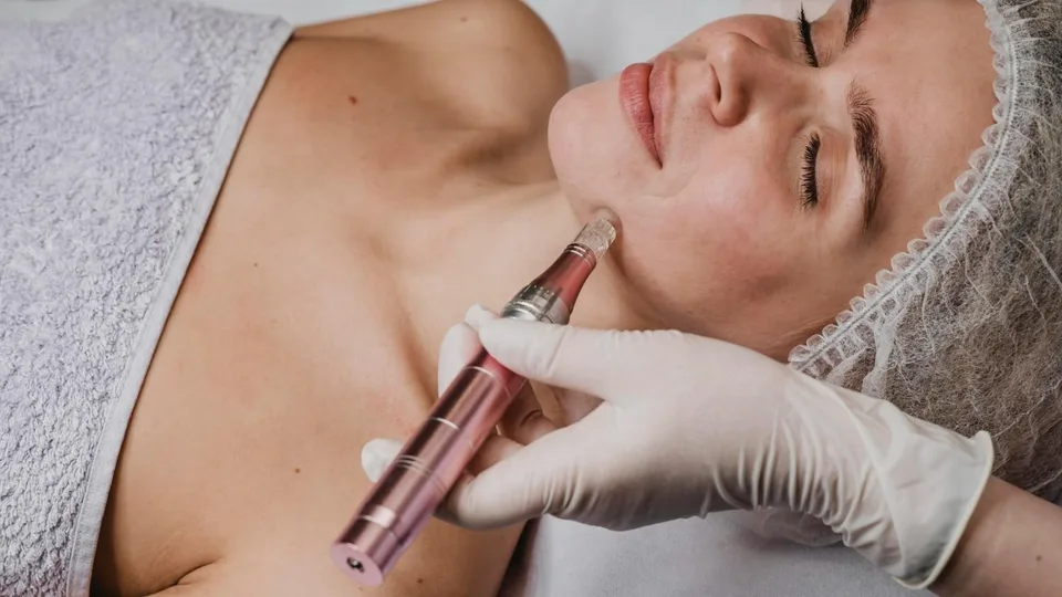 Microneedling treatment at Oxyderm